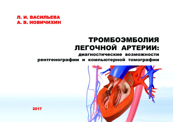 Тромбоэмболия легочной артерии. Книга 4. Диагностические возможности рентгенографии и компьютерной томографии