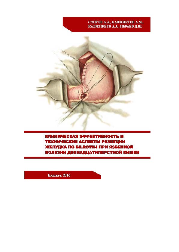 Клиническая эффективность и технические аспекты резекции желудка по Bilroth I при язвенной болезни двенадцатиперстной кишки