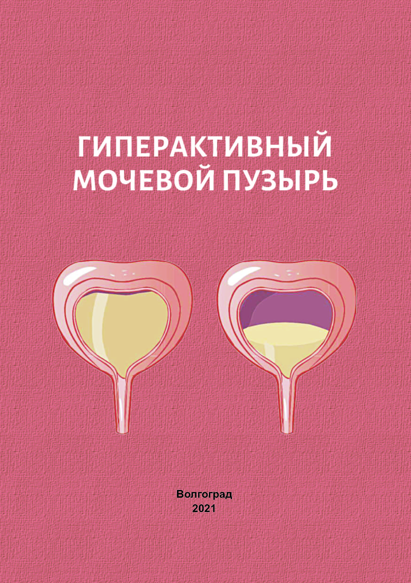 Гиперактивный мочевойпузыр. Гиперактивный мочевой пузырь презентация. Гипоактивый мочепвой пузырь. Гипоактивый мочепвой пузырь. Отзывы гиперактивный мочевой.